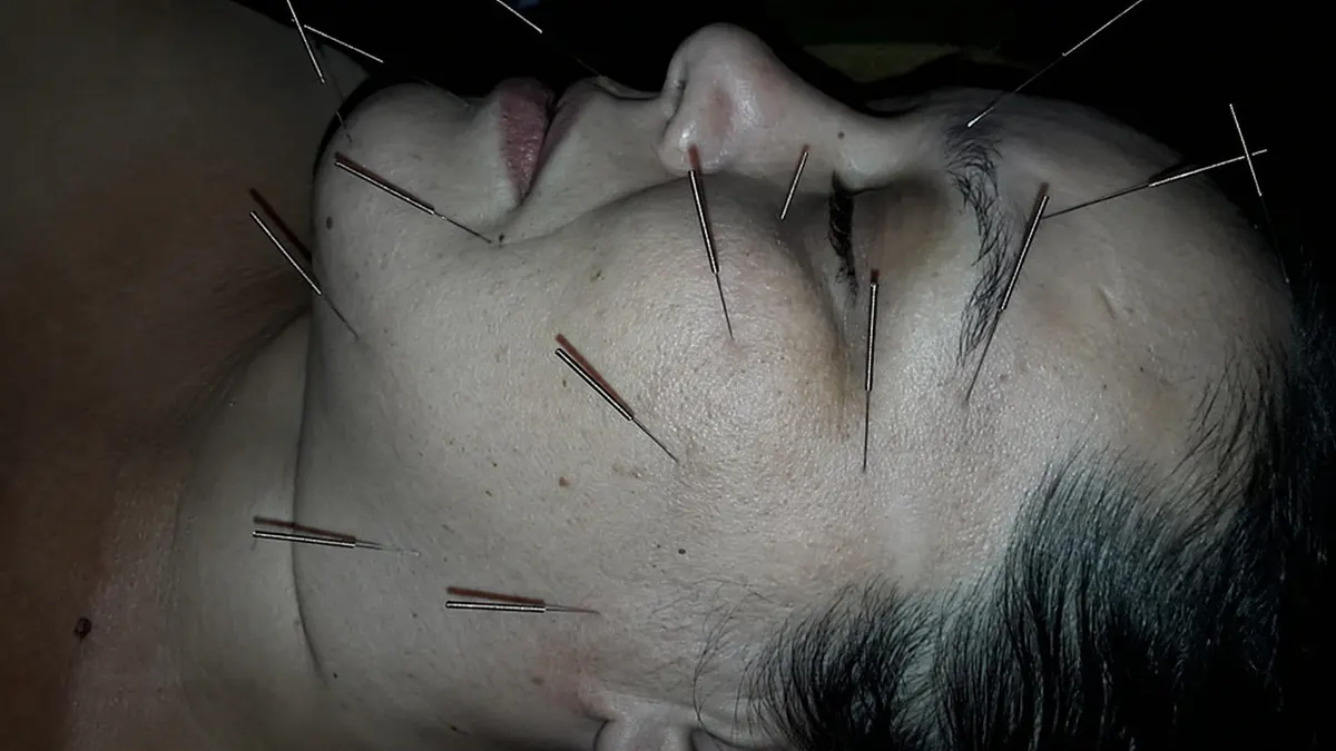 Paciente con acupuntura para recuperación de parálisis facial